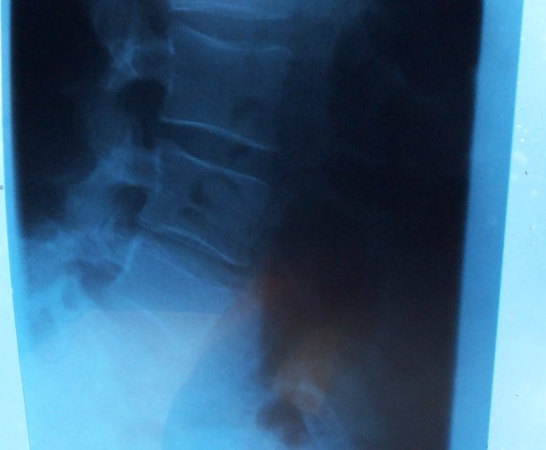 spondylarthrose.jpg