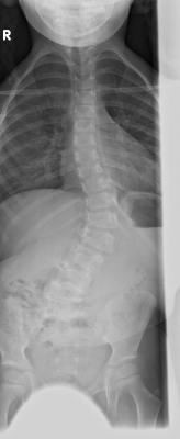 RöBi bei Erstdiagnose