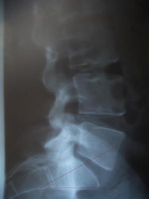 Lumbosacrale Hyperlordose.jpg