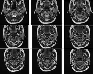Diese MRT-Aufnahmen stammen aus dem Jahre 2008. Men sieht von Bild zu Bild, wie der Digastricus aus dem Warzenfortsatz entsrpingt und nach ventral und medial entlang der Parotis zieht, um schließlich beim Zungenbein anzukommen.