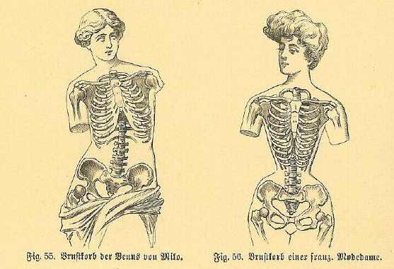 Rippentransformation durch Korsett Vom "Glockenthorax" zum "Burgfräulein-Konus"
<br />Aus "Die Frau als Hausärztin" von Dr. med. Anna Fischer-Dükelmann ( der ersten promovierten Ärztin!) von  1908 ( einer Zeit, in der grundsätzlich JEDE Frau enge Schnürkorsett