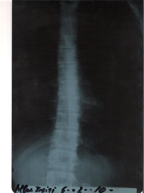 k-scoliosis1 001.jpg