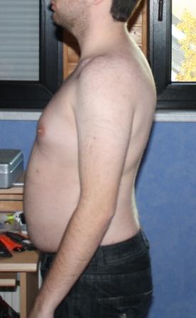 skoliose 1.JPG