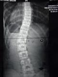 Das erste Bild ist, am 08. 04.2012, bevor der Therapie und Korsett-Tragen
