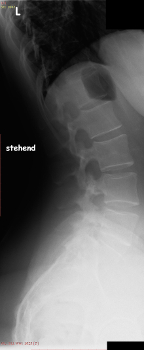 LWS: seitlich; Hyperlordose