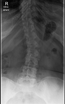 LSPINE