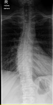 TSPINE