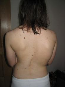 Daniela VOR Therapiebeginn mit 15 und 50°