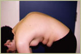 In dieser Position sieht man erst die Kyphose-Deformation der WS