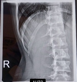 Klein (Röntgenbild Hemithorax rechts).jpeg