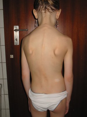Das ist Hannas Rücken